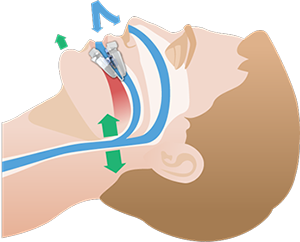 Illustrations for VitalSleep anti-snoring device.